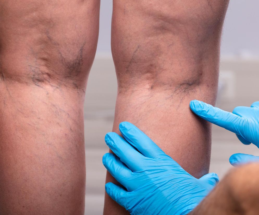 Ból nóg nasila się przy chodzeniu? Zagrożone są twoje płuca i serce, bo to mogą być objawy zakrzepicy