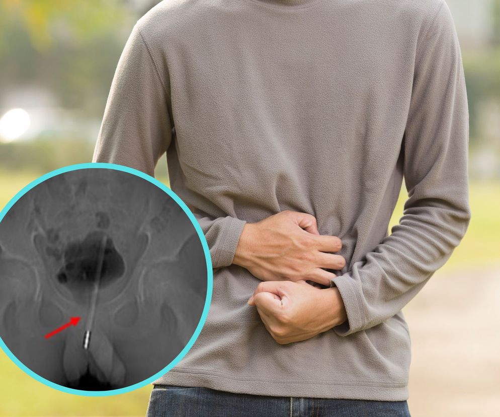 12-latek skarżył się na silny ból brzucha. Lekarze trafili na niezwykłe znalezisko w jego pęcherzu