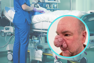 Człowiek słoń już tak nie wygląda. Przeszedł operację, wcześniej wstydził się wychodzić z domu