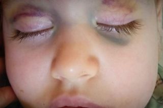 Zosia walczy z neuroblastomą. Rodzice sprzedali wszystko, by ją ratować. Teraz proszą o pomoc