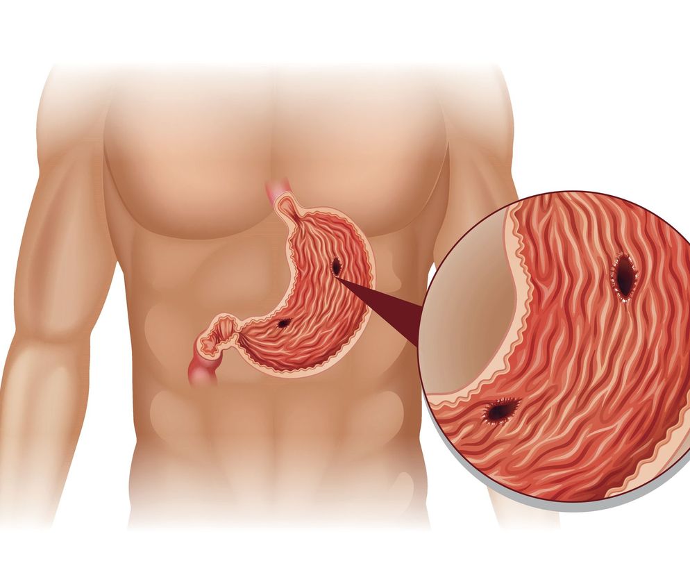 Wrzody żołądka wywołuje niezwykle sprytna bakteria - Helicobacter pylori. Trzeba ją zniszczyć antybiotykiem, bo nieleczona choroba w pewnych warunkach może przekształcić się w nowotwór. Jakie są objawy zakażenia Helicobacter pylori?