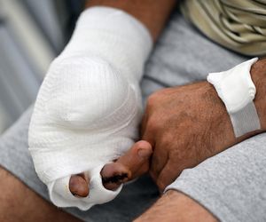 W 5 Klinicznym Szpitalu Wojskowym  Krakowie przyszyli panu Markowi kciuk