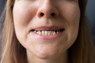 Na dr Smile nabrały się tysiące, nadal za to płacą. Czy można wyprostować zęby bez aparatu?