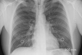 Czy płuca po koronawirusie się regenerują? Jest dobra wiadomość dla osób, które przeszły COVID-19