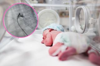 1,5-kilogramowy Karolek przeszedł operację serca. „Było wielkości truskawki” 