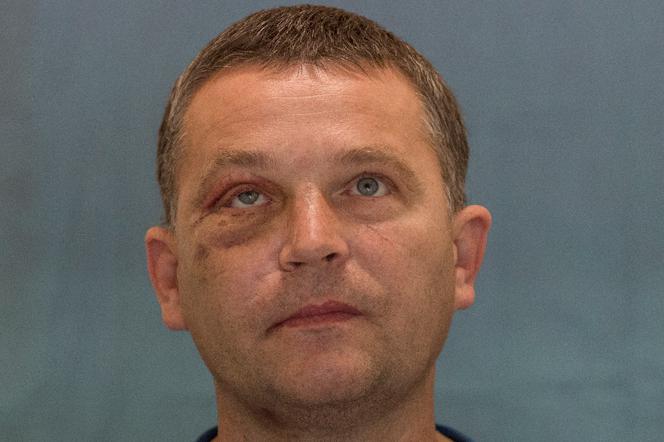 Wydrukowali mu nowe kości twarzy