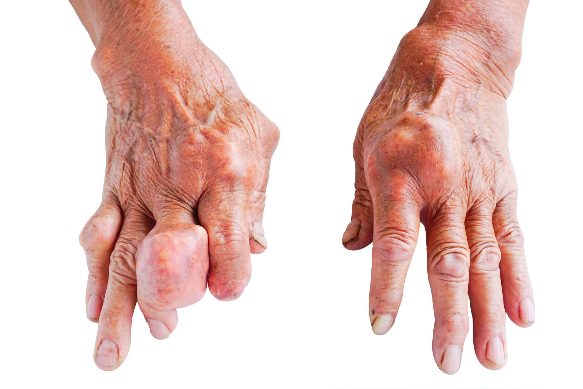 Dna Moczanowa Podagra Artretyzm Przyczyny Objawy Leczenia Poradnikzdrowie Pl