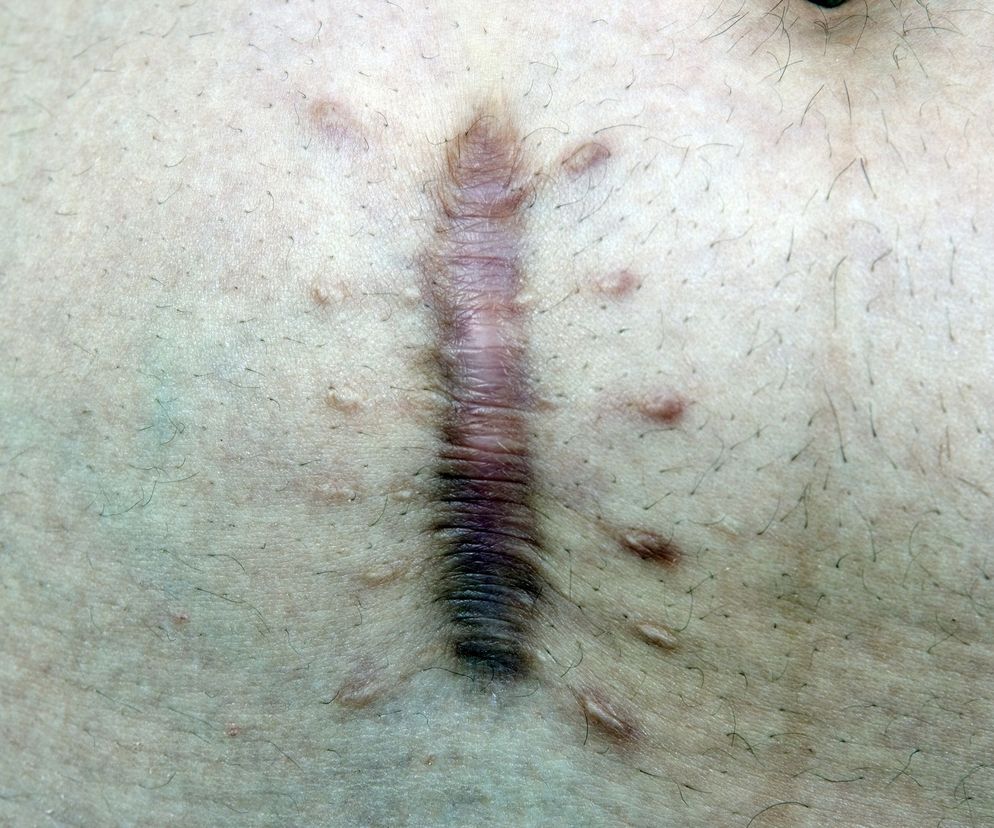 Bliznowiec (keloid) często boli, swędzi, a bardzo duży może powodować spory dyskomfort