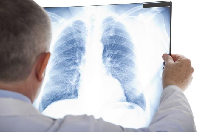 Śródmiąższowe zapalenie płuc - objawy, przyczyny, leczenie