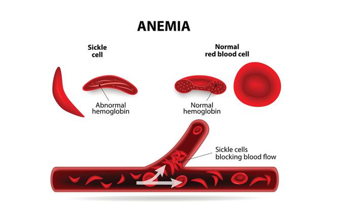 Anemia: brak żelaza. Objawy i przyczyny anemii