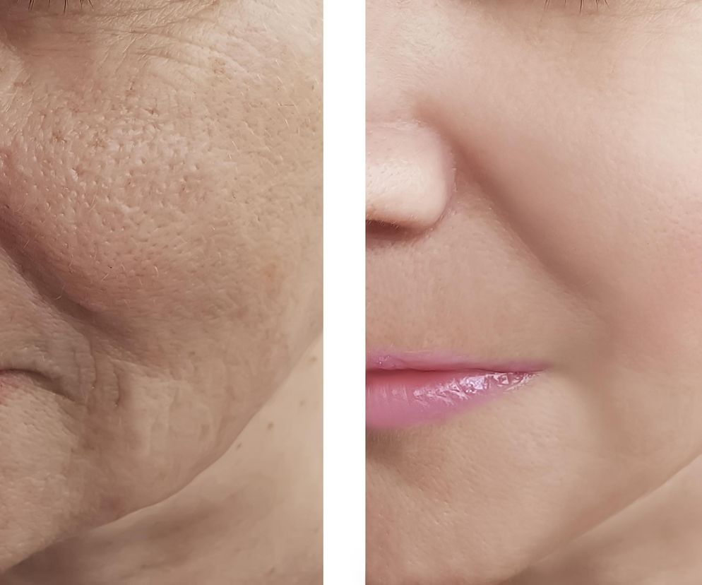 Domowa kuracja przeciwzmarszczkowa. Wykorzystaj te dwa produkty, a twarz wypięknieje