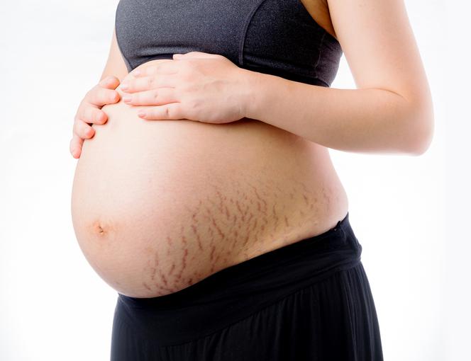 Rozstępy w zaawansowanej ciąży