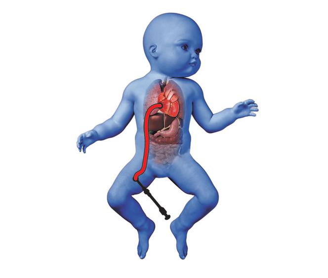 Naprawili serduszko 5-miesięcznej Mai