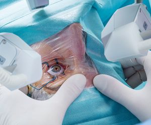 Irydotomia laserowa: przebieg, wskazania i przeciwwskazania