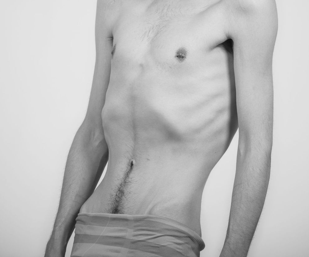 Kacheksja to wyniszczenie organizmu, którego najczęstszą przyczyną jest poważna choroba.