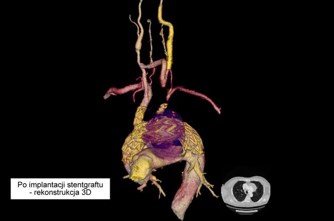Nowatorska operacja tętniaka łuku aorty w Uniwersyteckim Centrum Klinicznym WUM 2