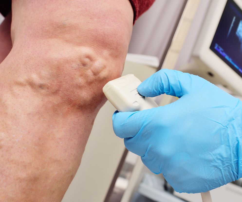 To może zmienić sposób leczenia miażdżycy. Jeden czynnik ważniejszy, niż cholesterol