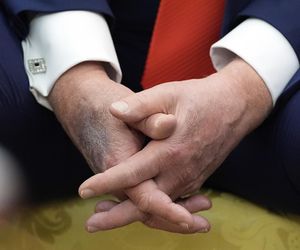 Donald Trump ma kłopoty ze zdrowiem. Nowe zdjęcia wywołały niepokój