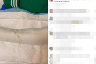 Gips Rozenek po wypadku żyje własnym życiem 