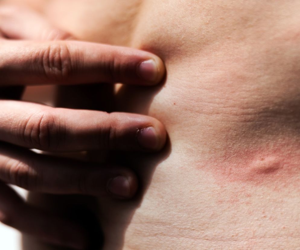 To pierwszy taki przypadek. Użądlenie osy skończyło się udarem