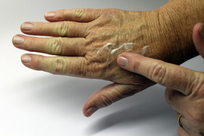 Zapuść 10 kropli i wklep w plamy starcze na dłoniach. Odmłodzi skórę i rozjaśni przebarwienia. Domowy sposób na plamy starcze