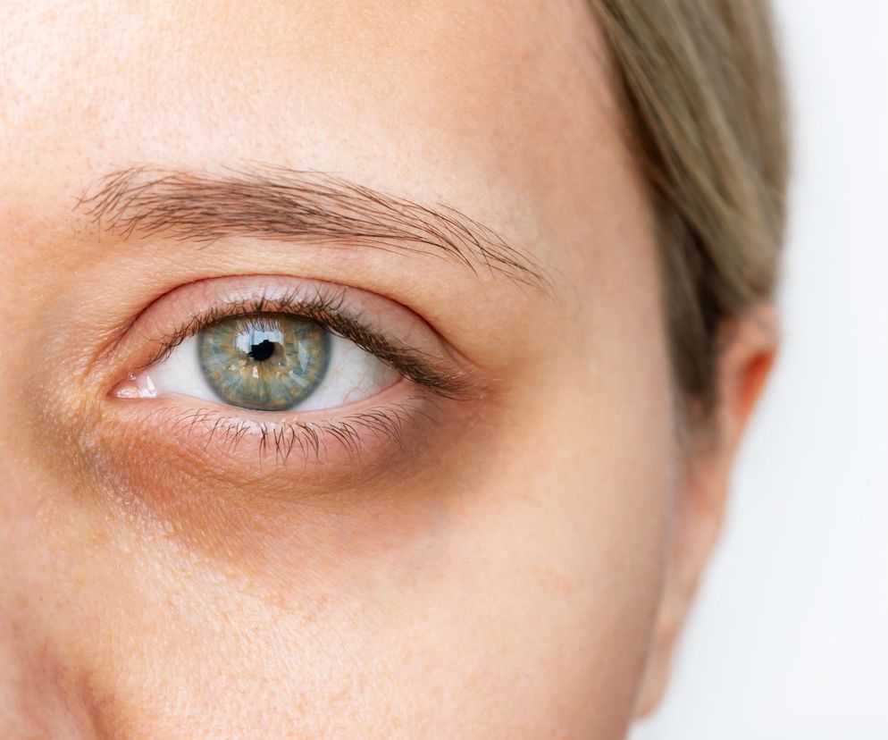 Ekspresowy sposób naszych babć na pozbycie się sińców pod oczami. To bezpieczne?