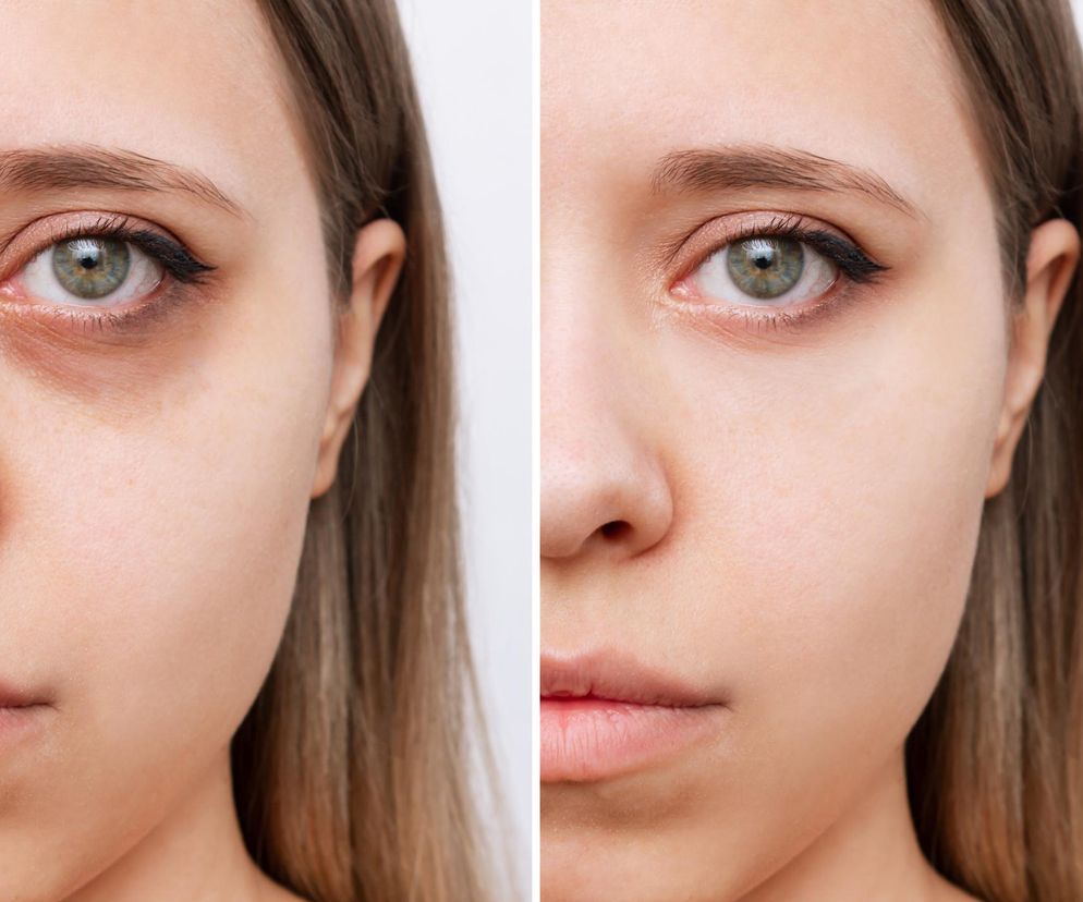 Najlepszy sposób na cienie pod oczami. Połącz 3 składniki, a po 15 minutach zobaczysz efekty