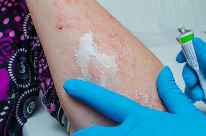Jakie metody leczenia stosuje dermatolog