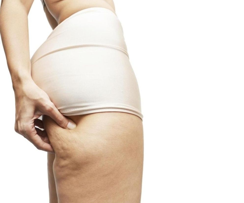 Cellulit może być ledwo widoczny, jeśli wynika jedynie z braku ruchu, małej elastyczności skóry. Może mieć też postać chorobową, jeśli w grę wchodzi również otyłość.