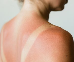 Lato w pełni. Co zrobić w przypadku przegrzania lub poparzenia?