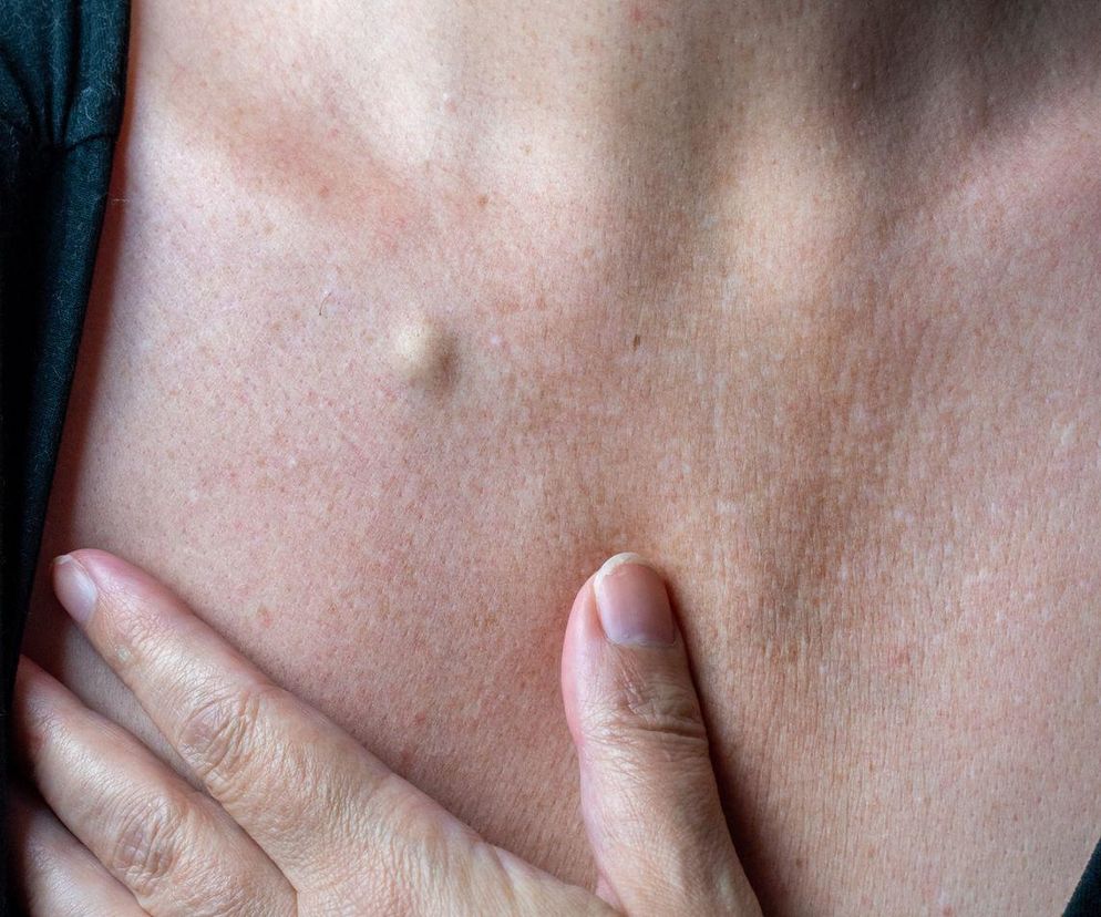 Wyciskasz, nakłuwasz, nacinasz, a kaszak ciągle ma się dobrze. Jak się go pozbyć, radzi dermatolog