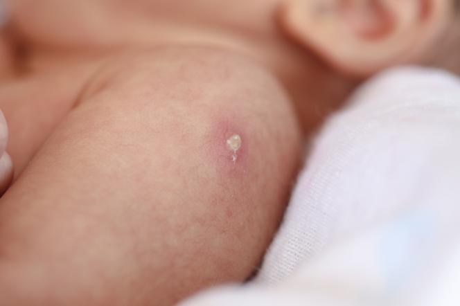 Po wykonaniu szczepienia, na rączce pojawia się białawy, mętny pęcherzyk.