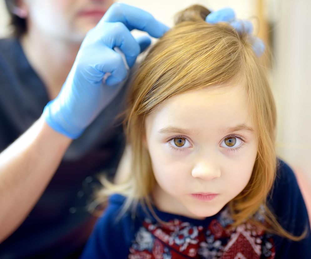 Na czystej głowie wesz się nie utrzyma. Wszy i mity o nich