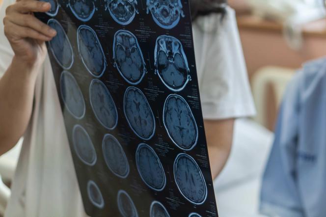 Na schorzenia neurologiczne cierpi nawet co trzeci Polak