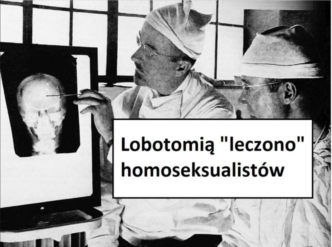 W tych przypadkach stosowano lobotomię