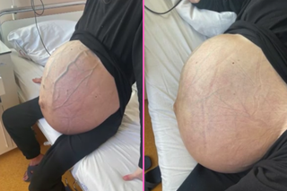 Wyglądała jakby była w ciąży. W jej brzuchu rósł 20-kilogramowy guz jajnika