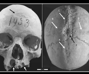 Fascynujące odkrycie archeologów. Czaszka kobiety pokazuje jak wyglądała średniowieczna chirurgia