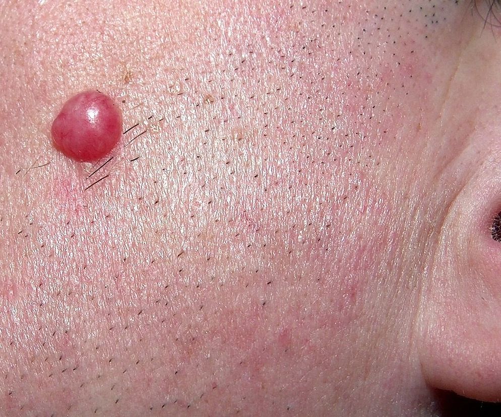 Borelioza limfatyczna - przyczyny, objawy, leczenie. Fot. Wikimedia Commons/Spectrum11, lic.CC0