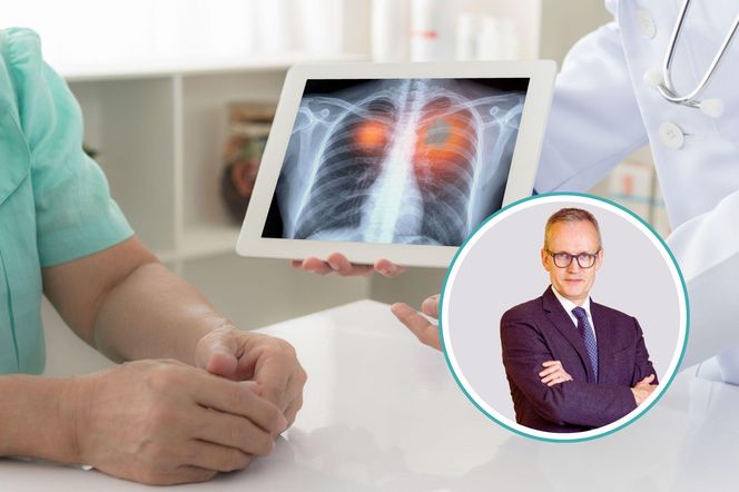 Pacjenci z rakiem płuca tracą bezcenne miesiące na diagnostykę. Ekspert wskazuje, co może wydłużyć życie tysięcy osób