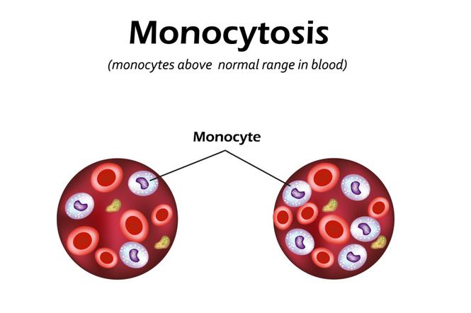 Monocytoza: przyczyny, objawy. Czy nadmiar monocytów jest groźny?