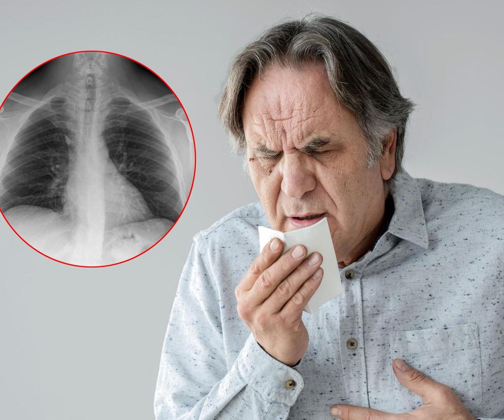 Powoduje raka płuc u osób, które nigdy nie paliły. Jest gorzej, niż myśleliśmy. Miażdżące badania