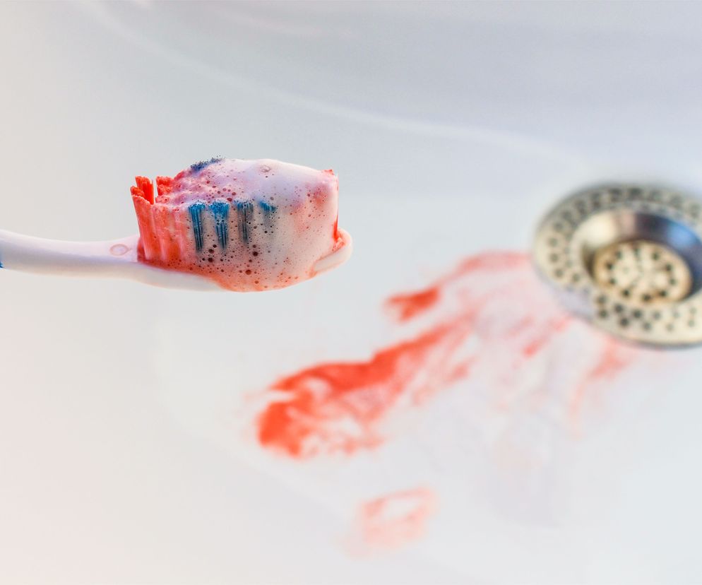 Zapalenie dziąseł objawia się m. in. krwawieniem podczas szczotkowania zębów.