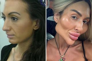 Ma największe policzki świata. Tak wyglądała 36-latka przed operacjami