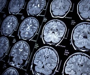 Odmian padaczki jest blisko 70 i jej ataki przebiegają różnie 