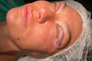 Monika Jarosińska przeszła operację by lepiej widzieć