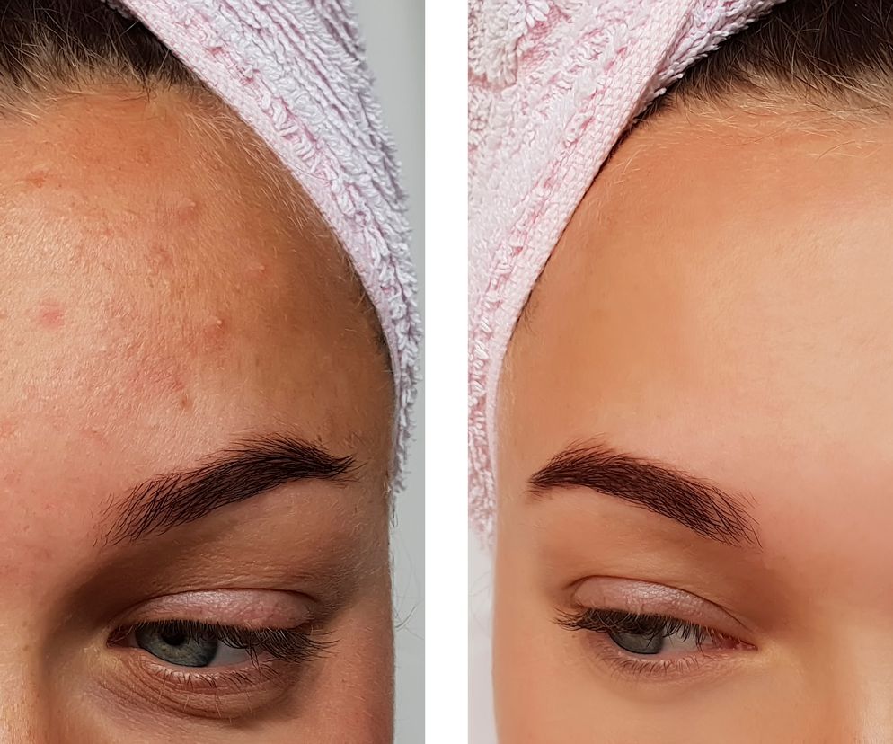 Spłyca zmarszczki i pozbywa się pryszczy. Przepis na ten prosty tonik ma 1000 lat