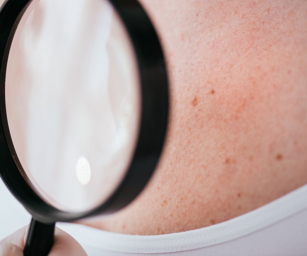 Dermatolog ogląda znamiona przez lupę