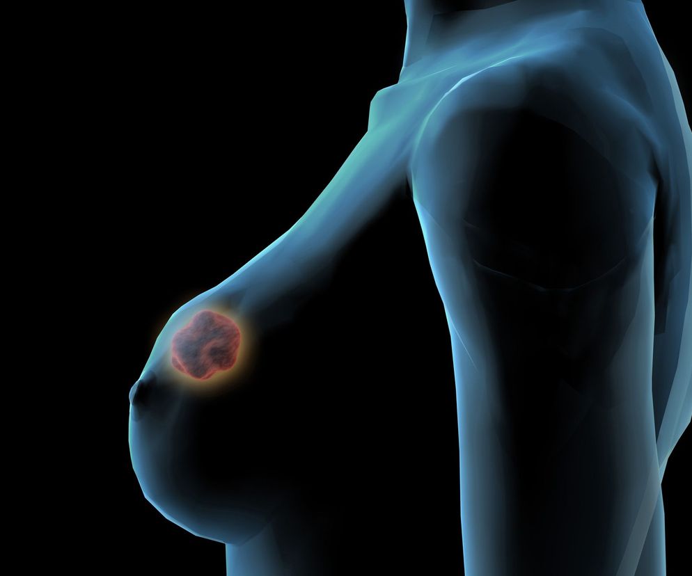 Rak piersi w wyniku rozrostu komórek przewodu mlecznego