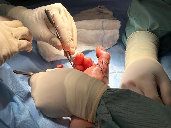 Lekarze z 5 Wojskowego Szpitala Klinicznego w Krakowie przyszyli oderwany kciuk panu Wojciechowi