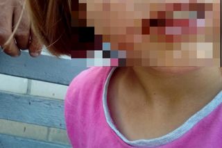 Spaliła kwasem ucho Julii. Rodzina broni wyrodnej matki, która latami torturowała 10-latkę